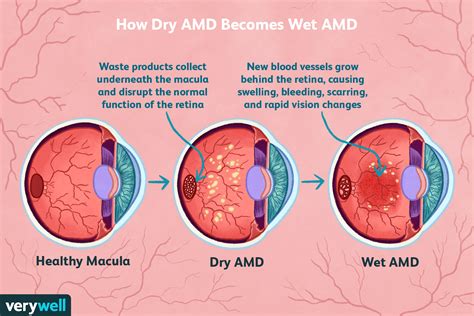 wet amd|wet macular degeneration treatment latest.